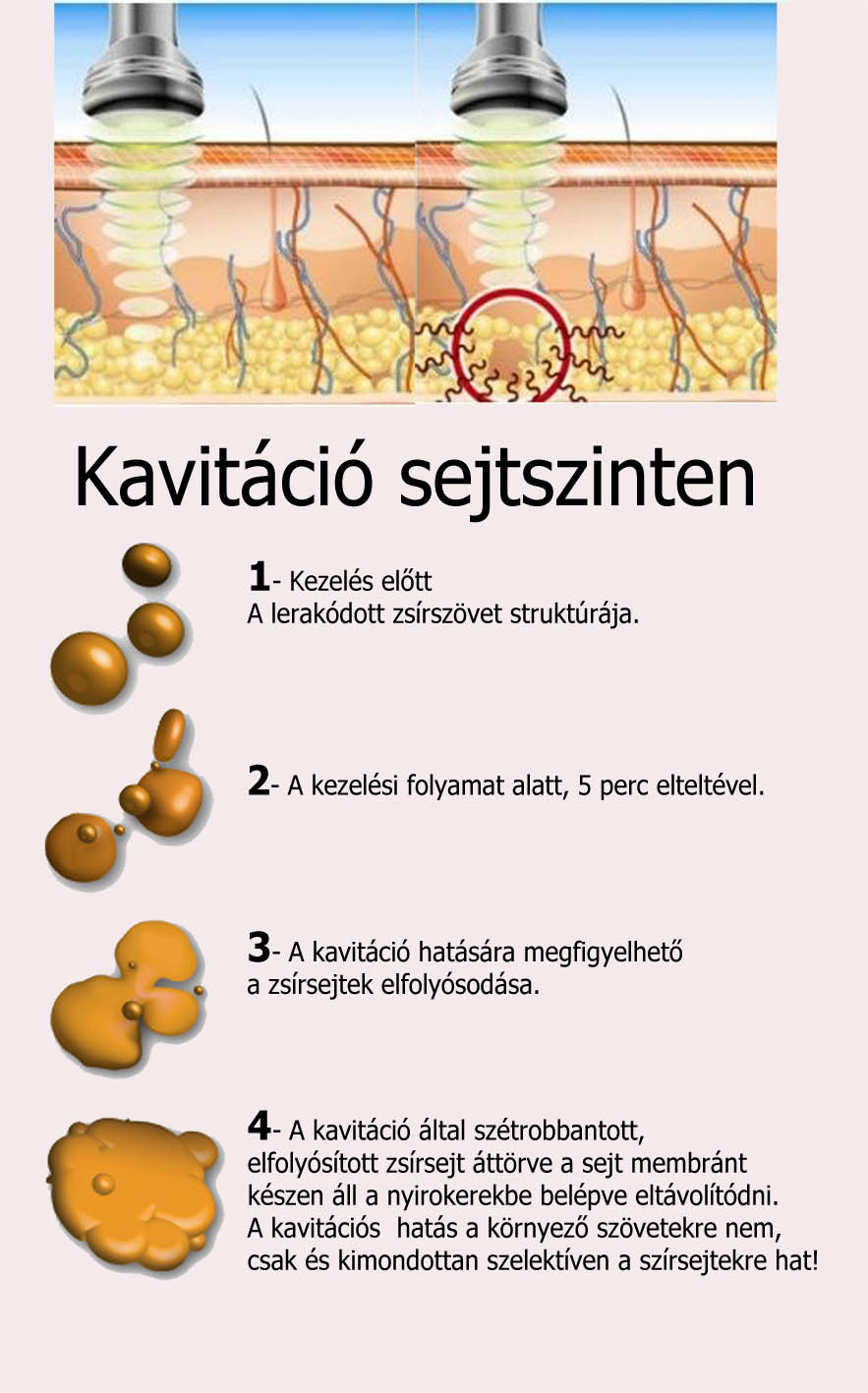 Kavitáció sejtszinten