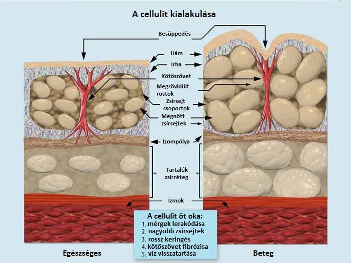 A cellulit kialakulása